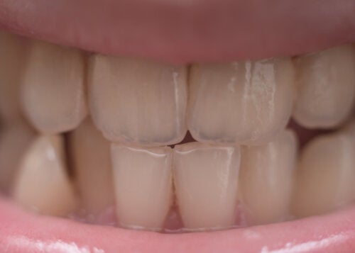 Kan fluoride het gebit van kinderen verkleuren?