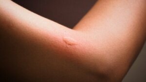 Gids voor het herkennen van insectenbeten bij kinderen
