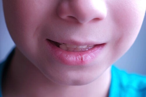 Gebarsten lippen bij kinderen: oorzaken en aanbevelingen