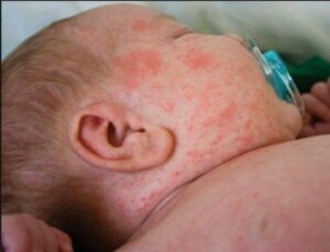 Wat zijn die kleine rode vlekjes op de huid van mijn baby?