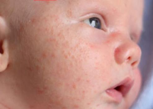 Wat is baby acne en wat kun je ertegen doen?