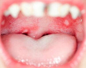 Gingivostomatitis bij kinderen: wat je moet weten