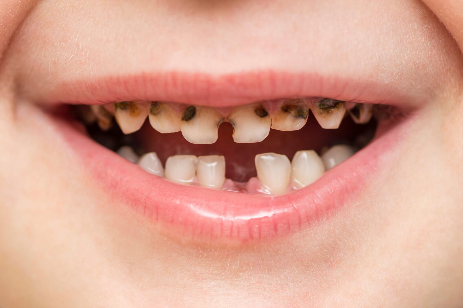 Een kind opent zijn mond en laat zijn tanden zien