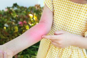 10 Tips voor de behandeling van contactdermatitis bij kinderen