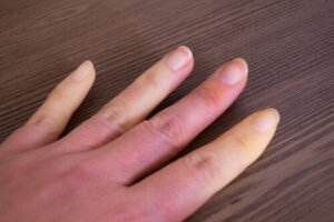 Wat is het syndroom van Raynaud?