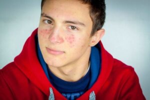 Acne bij tieners: do's en don'ts