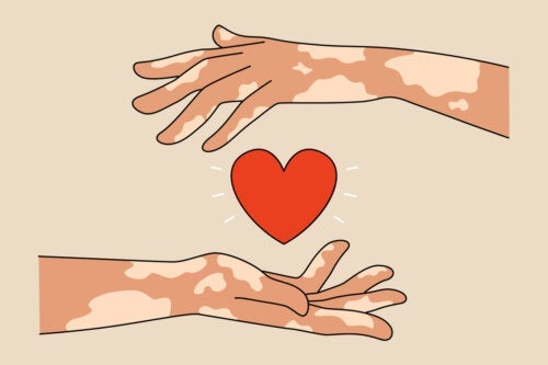 9 Tips voor ouders van kinderen met vitiligo