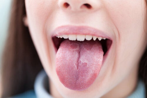 6 Kinderziekten die de tong kunnen aantasten
