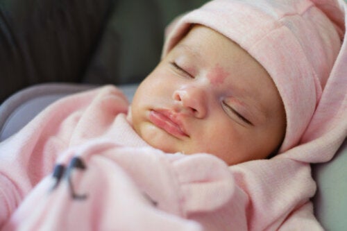 Engelenkus en ooievaarsbeet: vlekken op de huid van de baby