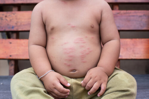 Kinderen met huidallergieën: symptomen en aanbevelingen