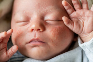 Mijn baby heeft een gevoelige huid