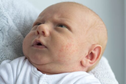 Milia bij baby's: wat je moet weten