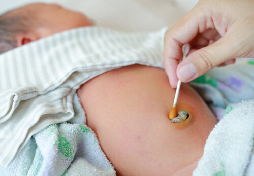 Omphalitis of navelinfectie bij pasgeborenen