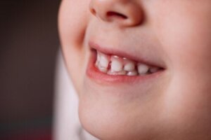 Wat is het Myobrace® systeem voor het uitlijnen van tanden?