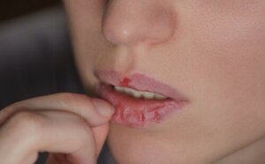 Zwangerschap en droge huid en lippen