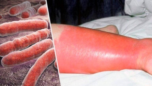 Erysipelas bij kinderen