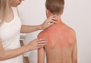 Zonnebrand bij baby's en kinderen: wat je moet weten
