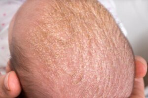 Hoe verwijder je berg bij baby's?