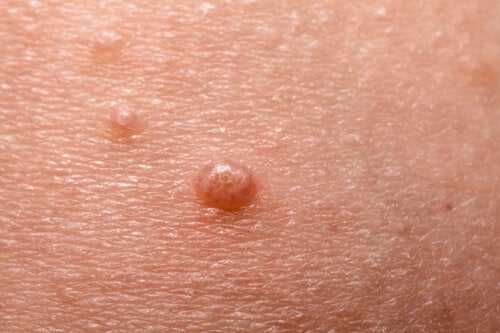 Molluscum contagiosum bij kinderen: wat je moet weten