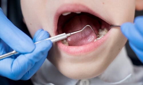 De 6 meest voorkomende tandheelkundige behandelingen bij kinderen