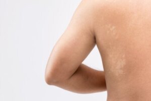 Pityriasis versicolor bij baby's en kinderen