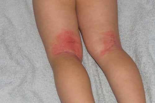 Erytrodermie bij kinderen: symptomen, oorzaken en behandelingen