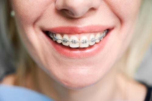 Is orthodontie tijdens de zwangerschap veilig?