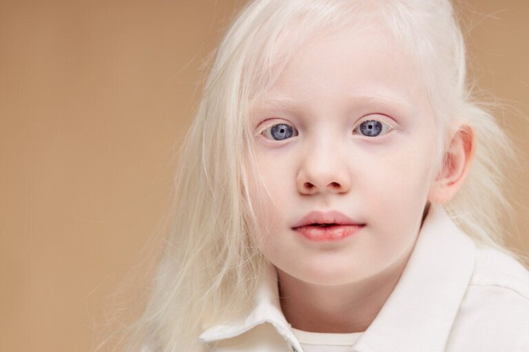Hoe verzorg je de huid van kinderen met albinisme?