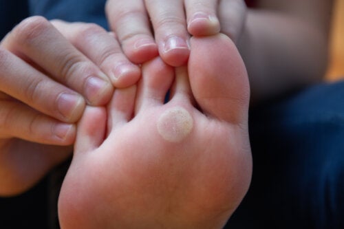 Plantaire wratten bij kinderen: hoe te behandelen?