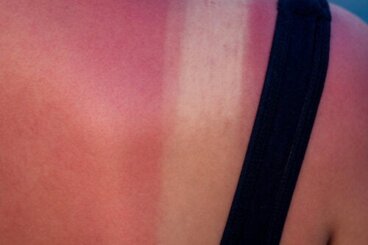 Zonnebrand tijdens de zwangerschap: risico's en behandeling