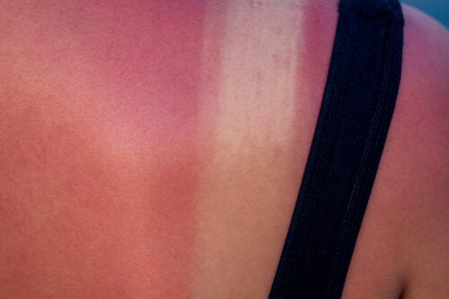 Zonnebrand tijdens de zwangerschap: risico's en behandeling