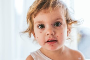 Acne bij jonge kinderen: wat je eraan kunt doen